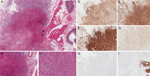 Immunohistochemical staining. (A) Hematoxylin and eosin stain (H&E stain). (BandC) H&E stain with magnification 4× and 20×. (D) Anti-cytokeratin AE1/AE3 + (5×). (E) Vimentine + (4×). (F) ActineML + (4×). (G) CD99 + weak (10×). (H) CD117 − (2×). (I) Desmin – (4×).
