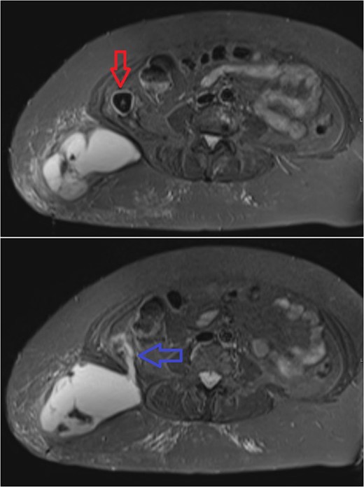 Subsequent axial MR sections of the pelvis. In the first image a large superficial collection can be seen in the soft tissues of the right lower back with surrounding fat stranding. A partially calcified, roughly spherical mass (3 cm in diameter) can be seen, walled-off within the abdominal cavity (red arrow). The second, more inferior section demonstrates communication (blue arrow) between the abscess cavity, through the belly of quadratus lumborum, and the calcified mass.