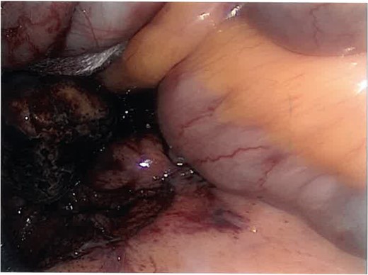 Laparoscopic view of the dropped stone in the right para-colic gutter (caecum inverted top right).