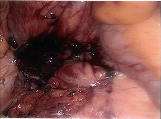 Post-excision laparoscopic view of the posterior abdominal wall cavity.