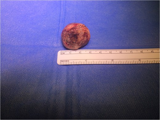 A 3 cm mixed pigment cholelith excised from the abdominal cavity, presumably dropped at laparoscopic cholecystectomy over 20 years previously.