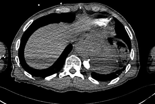 CT aortogram showing the extravasation of contrast into the stomach.