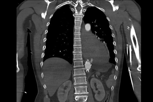 CT aortogram showing the extravasation of contrast from the aorta just proximal to the stent graft.