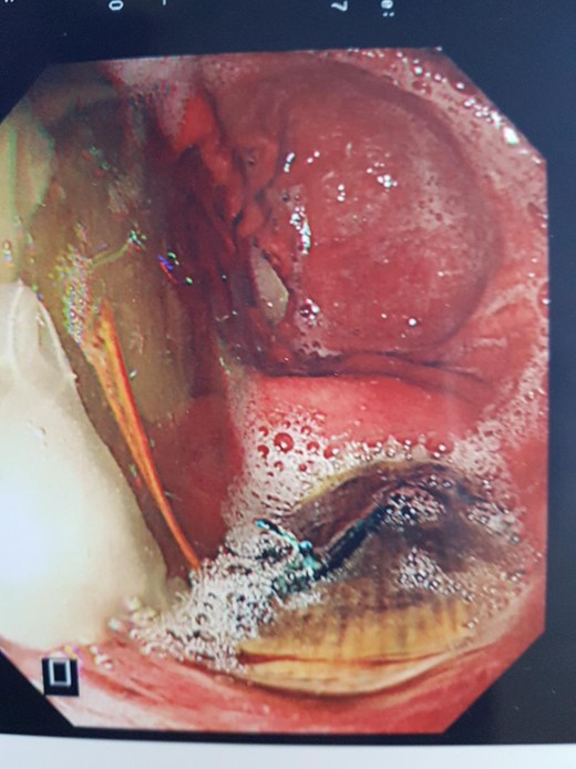 Endoscopic view of aortic stent graft in base of gastric ulcer.