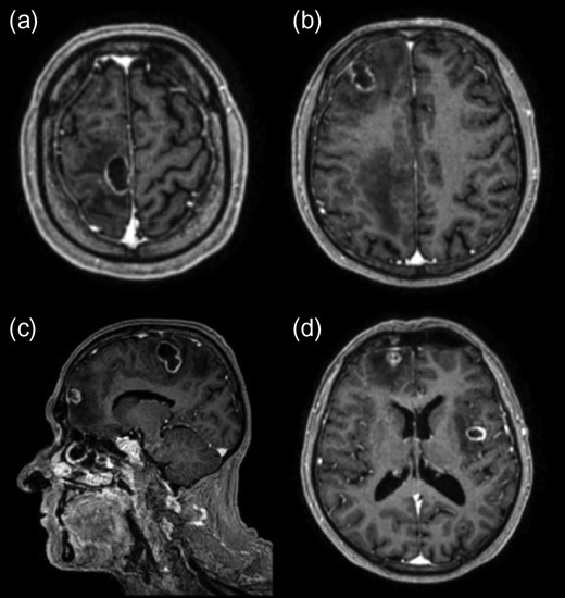 Initial post-contrast T1-weighted MRI demonstrating three lesions involving the right frontal lobe (a, b, c) with another in the left lateral occipital lobe (d) and one in the left insular region (d). The lesions also displayed complex walls typical of an abscess capsule on T2-weighted imaging and demonstrated central diffusion restriction (not shown).
