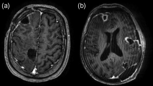 Post-contrast axial T1-weighted MRI following resection of abscesses in the right frontal lobe (a, b), left insular region (b) and left occipital lobe (b).