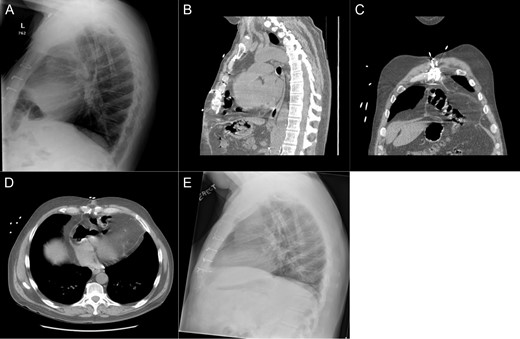 Imaging from Case #1. (A) Preoperative X-ray demonstrating loop of bowel in the thoracic cavity. (B) Preoperative CT scan, saggital view of diaphragmatic defect. (C) Preoperative CT scan, coronal view demonstrating colon passing through diaphragmatic defect. (D) Preoperative CT scan, axial view demonstrating intrapericardial transverse colon. (E) Postoperative X-ray demonstrating reduction of hernia contents.