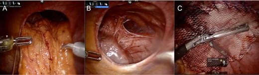 Intraoperative Images from Case #1. (A) Reduction of omentum and transverse colon through hernia defect. (B) Representative image of defect following reduction of intra-abdominal contents; heart border visible to lower left of defect. (C) Following placement of mesh for repair of diaphragmatic hernia.
