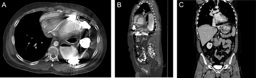 Imaging from Case #2. (A and B) Preoperative CT scan demonstrating loop of bowel in the thoracic cavity posterior to the heart and LVAD. (C) Postoperative CT scan, coronal view demonstrating repair of the diaphragmatic defect with mesh overlay.