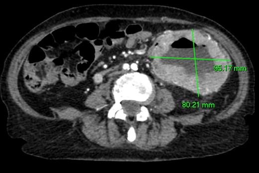 Axial CT imaging. Large exophytic cavitating lesion arising from jejunum with no evidence of active haemorrhage.