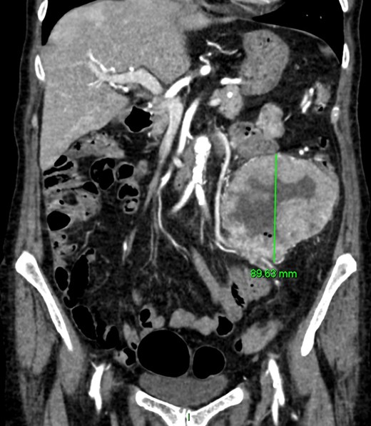 Coronal CT imaging. Large exophytic cavitating lesion arising from jejunum with no evidence of active haemorrhage.