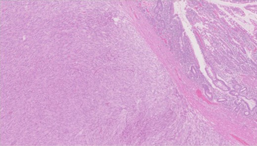 Low power H&E for tumour in relation to bowel mucosa.