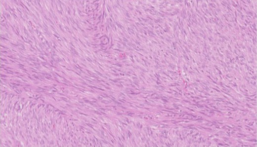 Higher power view showing the spindle appearance of tumour cells.