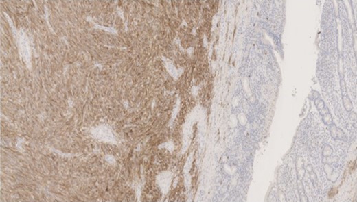 Immunohistochemical positivity for CD117.