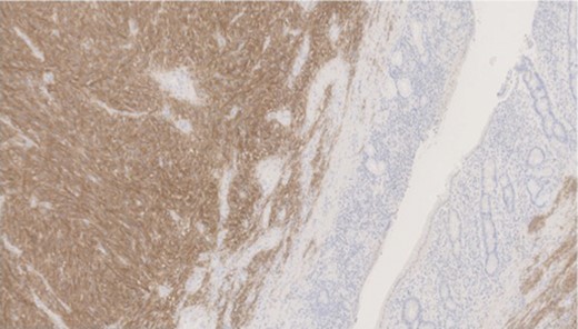 Immunohistochemical positivity for DOG1.