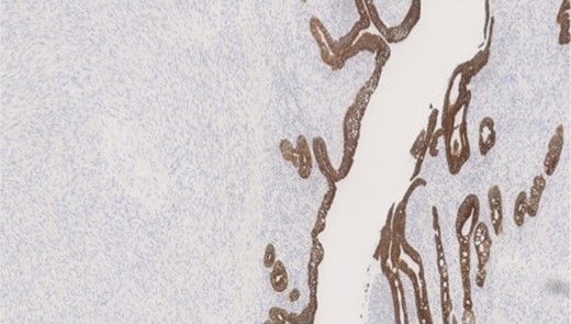 MNF staining the epithelium of the bowel while is negative in tumour cells.