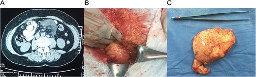(A) Computed tomography (CT) with a 9 × 7 × 4 cm mass within the small bowel mesentery near the root of the mesentery. (B) Mass in the root of small bowel mesentery near the mesenteric vessels. (C) External surface of the mass.