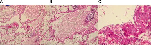 (A) Adipose tissue covering lymphatic vessels with eosinophil content. (B) Dilated lymphatic vessel with a cluster of lymphocytes. (C) Cyst epithelium.