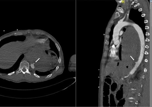 CT angiogram showing aorta-enteric fistula demonstrated by arrow (axial and sagittal view, respectively).