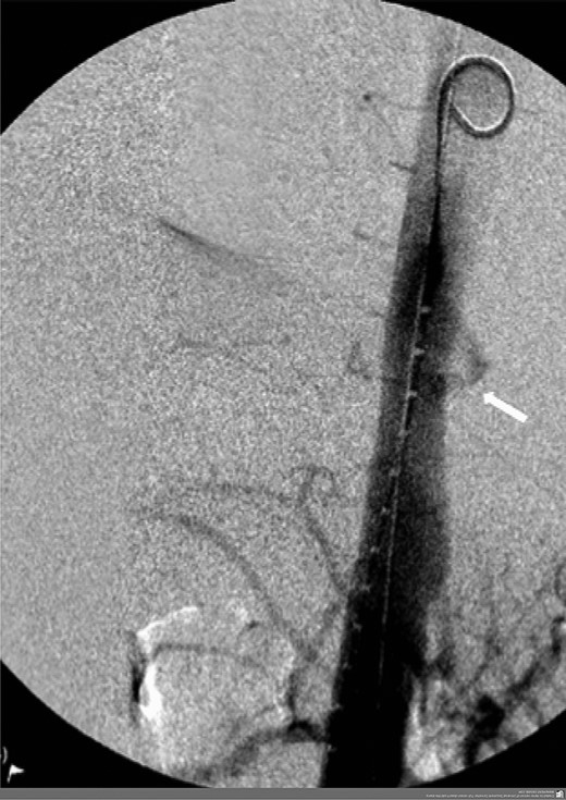Angiogram prior to primary aortic stenting; leak via fistula demonstrated by arrow.
