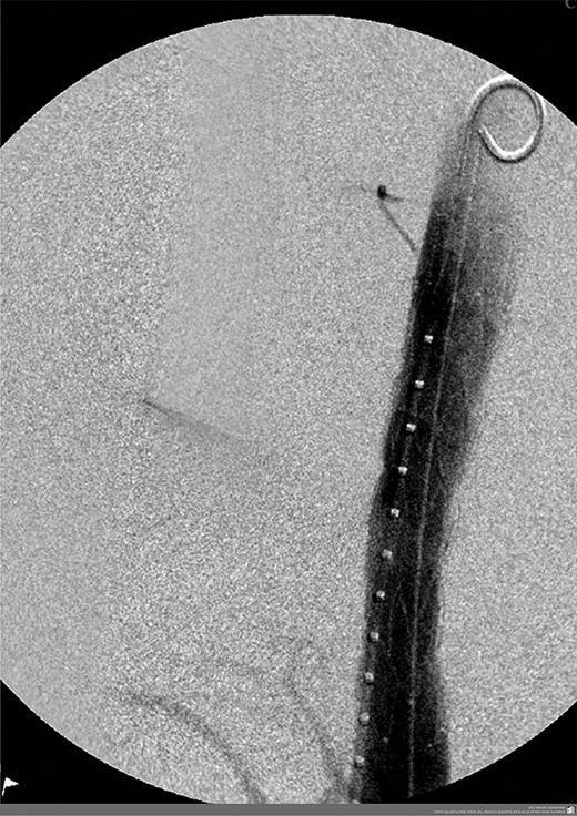 Angiogram post primary aortic stenting.