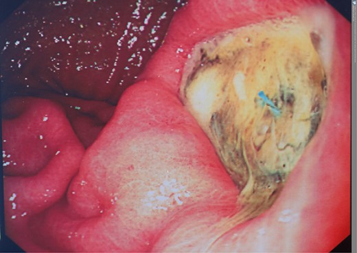 OGD following primary stent insertion showing enteric ulcer.
