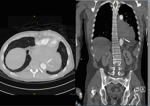 Second admission: CT angiogram showing aorta-enteric fistula demonstrated by arrow (axial and sagittal view, respectively).