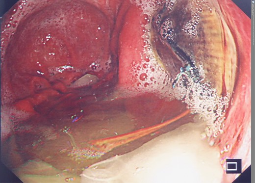 Second admission: OGD post second stent insertion demonstrating visibility of aortic stent via defect in wall of neo-oesphagus.
