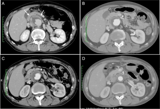 (A) Contrast-enhanced computed tomography scan at the time of admission showing a 50-mm juxtarenal abdominal aortic aneurysm surrounded by dense fibrous tissue (white arrows). (B and C) The perianeurysmal fibrous tissue became smaller along with the course of steroid therapy, 7 and 14 days after the initiation of steroid therapy, respectively. (D) Postoperative computed tomography scan showing a patent graft with near disappearance of the fibrous tissue.