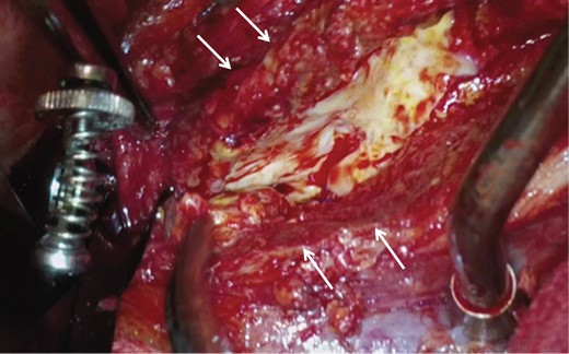 Intraoperative image showing that a small range of the aneurysmal wall was severely thickened (white arrows) but the fibrotic change of the retroperitoneum was limited.