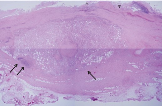 Light microgram of the hematoxylin and eosin-stained aortic wall revealing the collapsed structure of the tunica intima (single asterisk), and the marked thickening in the tunica adventitia due to infiltration by inflammatory cells (black arrows) accompanied with fibrous proliferation.