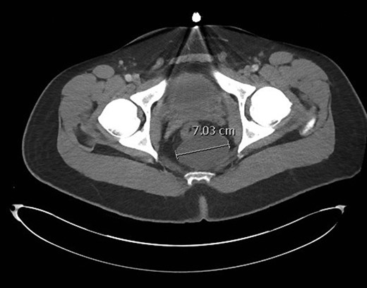 CT pelvis image demonstrating a 7.0 cm retrorectal cyst. The rectum is noted anterior to the cyst, and just to the right of midline.