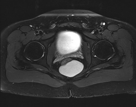 MRI pelvis demonstrating the retrorectal cysts, again with the rectum anterior and just to the right of midline.