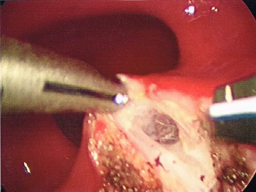 Opening of the posterior wall of the rectum, into the posterior perirectal space.