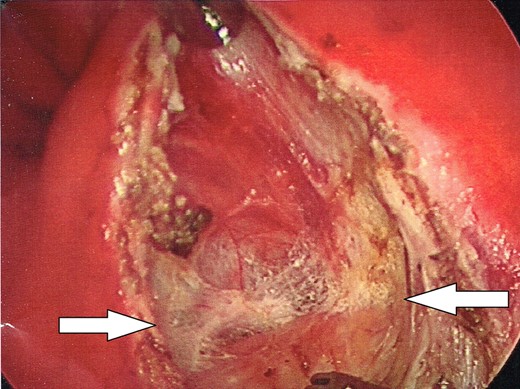 Enlargement of the proctotomy. The plane of dissection is visible (indicated by arrows), with the dome of the cyst seen at the bottom of the image.