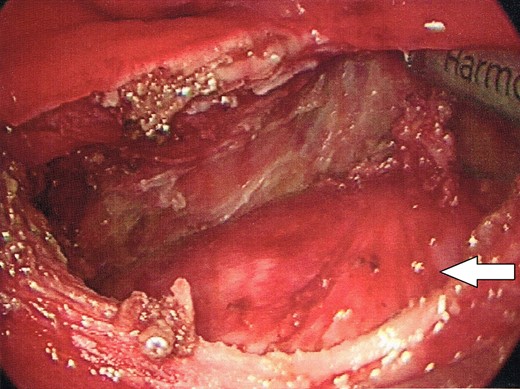 The dome of the cyst is visible at the bottom of the image (indicated by arrow), with a dissection plane visualized above.