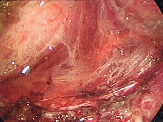 Cavity of the resection site after cyst resection.