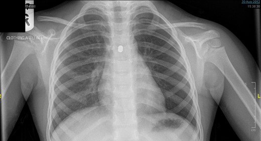Initial posterior–anterior chest x-ray (CXR) demonstrated a translucent left lung with reduced peripheral lung markings. There is also a dense rounded foreign body projected over the left main bronchus. A label of ‘CLOTHING ARTEFACT’ was placed in the left upper corner of this CXR.