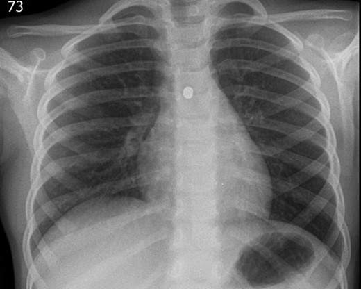 The repeated posterior–anterior CXR taken with all clothes and hair removed from the thorax of the patient. It confirmed the presence of a metallic foreign body in the left main bronchus.