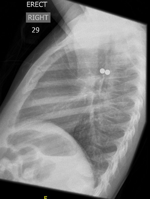Lateral CXR showed the metallic foreign body to be two spherical balls, with the anterior one in the left main bronchus and the posterior one in the oesophagus.