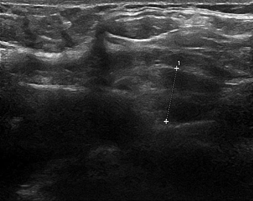 Ultrasound neck image illustrating the parathyroid adenoma measuring 11 mm with echogenicity and internal vasculature.