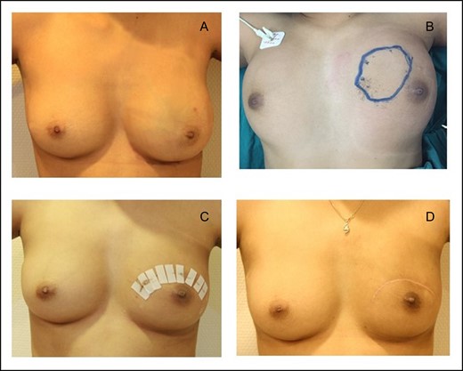 (A) Asymmetrical enlargement of left breast with tumour occupied entire left breast. (B) Post radiation, the ultrasound skin mark located the demonstrable tumour. (C) Post wide excision Day 7. (D) A post wide excision 6 months.