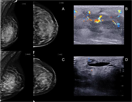 (A and B) Mammogram and ultrasound showed an ill-defined big mass at left mid inner quadrant with hypervascularity, subdermal edema and overlying skin thickening. (C and D) Mammogram and ultrasound post radiation showed 5.4 × 2.4 cm2. Ill-defined mass at left upper to mid inner quadrant with interval decreased internal hypervascularity.