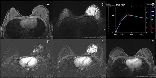 (A) Breast MRI showed isosignal intensity in T1WI with hemorrhagic spot (arrow). (B) Breast MRI showed strongly high signal intensity in T2WI. (C) Signal time curve showed type 2 and type 3 kinetic curve pattern but type 2 in majority. (D) Breast MRI showed rapid arterial enhancement in early arterial phase. (E) Breast MRI showed mixed plateau and washout enhancement in delayed phase. (F) Breast MRI post radiation showed interval decreased in size, currently showed slow arterial enhancement with persistent enhancement on delayed phases (type I kinetic).