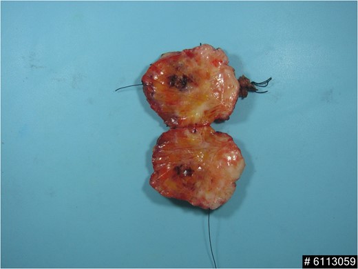 Wide excision specimen showed area of congested red pigmented tissue with internal hemorrhage.