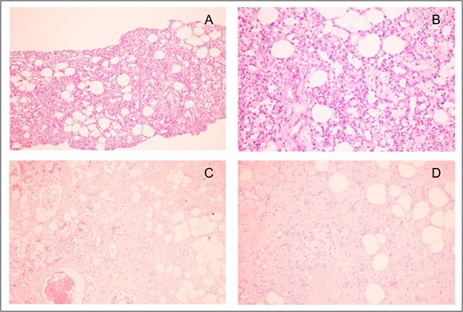 (A) Original magnification ×100 and (B) original magnification ×400: Core needle biopsy specimen showed spindle-shaped cells proliferation, forming capillary-like vascular channels. Each space calibre is lined by single layer of bland-looking spindle cells, possessing oval hyperchromatic nuclei with fine chromatin. (C) Original magnification ×400 and (D) original magnification ×400: Wide excision specimen revealed proliferating endothelial cells forming small vessels with proliferative vessels. Some area elicited aggregates of congested vessels.