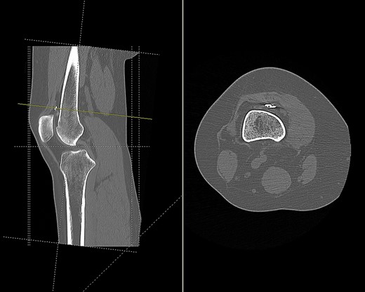 CT scan of the right knee showing the endobutton in suprapatellar pouch (sagittal and axial view).