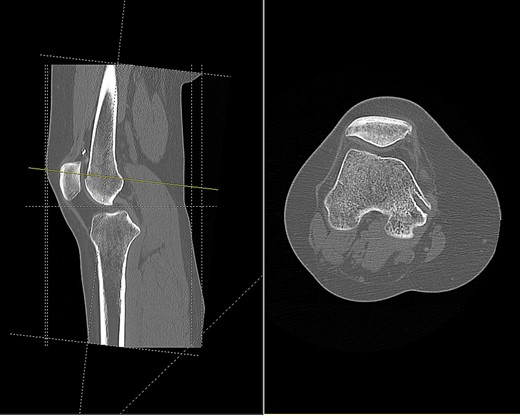 CT scan of the right knee showing entry point and oblique path of femoral tunnel at medial epicondyle (sagittal and axial view).