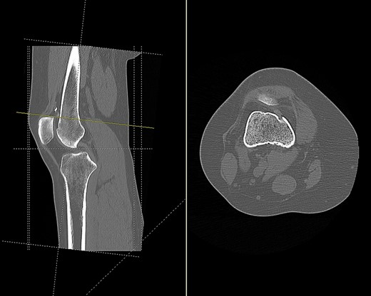 CT scan of the right knee showing perforation of anterior femoral cortex (sagittal and axial view).