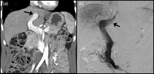 Radiological assessment of the patent ductus venosus (PDV) by (a) computed tomography and (b) digital subtraction angiography. Black arrow: PDV traversing towards the inferior vena cava.